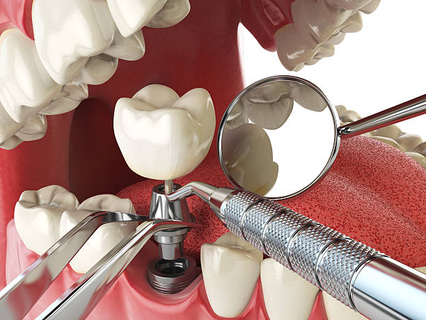 Best Emergency Tooth Extraction in Central Park, WA